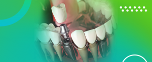 Duração de implantes dentários - ABO Sorocaba