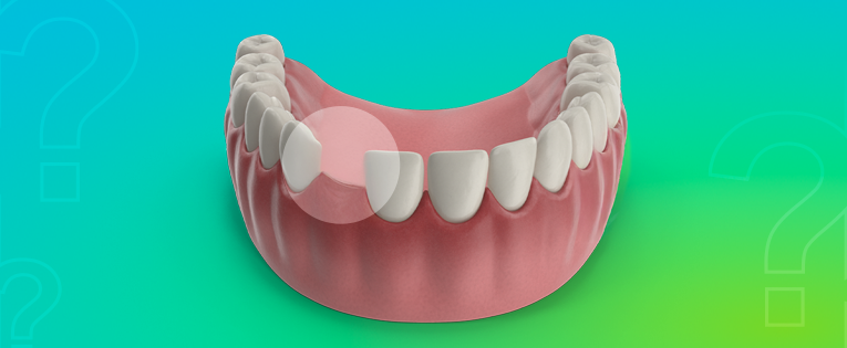 implantes dentários