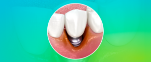 peri-implantite