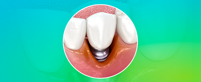 peri-implantite