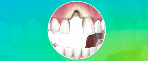 implantes dentários