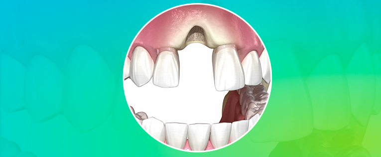 implantes dentários